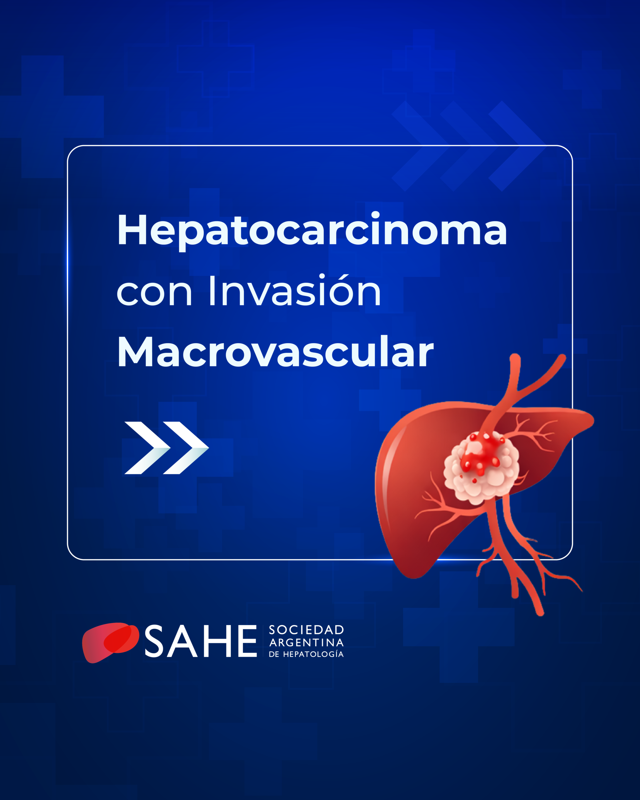 Trabajo Colaborativo: Hepatocarcinoma con invasión macrovascular
